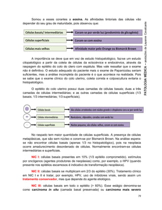 79
Somou a esses corantes a eosina. As afinidades tintoriais das células vão
depender do seu grau de maturidade, pois observou que:
A importância se deve que em vez de estudo histopatológico, faz-se um estudo
citopatológico a partir da coleta de células da ectocérvice e endocérvice, através da
raspagem do epitélio do colo do útero com espátula. Mas vale ressaltar que o exame
não é definitivo. O estudo adequado do paciente mais o exame de Papanicolau seriam
suficientes, mas a análise incompleta do paciente é o que acontece na realidade. Pois
se sabe que o exame clínico do colo uterino, coleta correta e colposcultura evitaria o
histopatológico.
O epitélio do colo uterino possui duas camadas de células basais; duas a três
camadas de células intermediárias; e as outras camadas de células superficiais (1/3
basais; 1/3 intermediárias; 1/3 superficiais).
No raspado tem maior quantidade de células superficiais. A presença de células
metaplásicas, que são sem núcleo e coram-se por Bismarck Brown. Na análise espera-
se não encontrar células basais (apenas 1/3 no histopatológico), pois na neoplasia
ocorre amadurecimento desordenado de células. Normalmente encontram-se células
intermediárias e superficiais.
NIC I: células basais presentes em 10% (1/3 epitélio comprometido), estímulos
por oncógenos (agentes produtores de neoplasias) como, por exemplo, o HPV (quando
presente nos epitélios escamosos é indicativo de transformação neoplásica).
NIC II: células basais se multiplicam em 2/3 do epitélio (30%). Tratamento clínico
em NIC I e II é tratar, por exemplo, HPV, uso de inibidores virais, sendo assim um
tratamento conservador, mas que depende do agente etiológico.
NIC III: células basais em todo o epitélio (> 60%). Esse estágio denomina-se
como carcinoma in situ (camada basal preservada) ou carcinoma mais severo
 