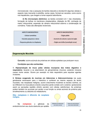 28
microvesicular, mas a pesquisa de lipídios descarta a dúvida).Em algumas células o
aspecto mais marcante é acidofilia, outras vezes, formam-se vacúolos, como ocorre
nos hepatócitos, que chegam a tomar aspecto baloniforme.
2) No microscópio eletrônico: as lesões consistem em < das vilosidades,
formação de bolhas na membrana citoplasmática, dilatação do RE, contração da
matriz mitocondrial, expansão da câmara mitocondrial externa e condensação da
cromatina. Todas são alterações reversíveis.
Degeneração Mucóide
Conceito: ocorre acúmulo de proteínas em células epiteliais que produzem muco.
Condições que são conhecidas:
1. Hiperprodução de muco pelas células mucíparas dos tratos digestivo e
respiratório: levando a se abarrotarem de glicoproteínas (mucina), podendo inclusive
causar morte celular. Ocorre por exemplo no trato respiratório para expulsar agentes
invasores.
2. Síntese exagerada de mucinas em Adenomas e Adenocarcinomas (as quais
geralmente extravasam para o interstício e conferem ao mesmo aspecto de tecido
mucóide): nas neoplasias malignas, ocorre crescimento invadindo os tecidos vizinhos, ao
se infiltrarem na musculatura e tecido conjuntivo perde contato com o exterior, aprisionando
assim as secreções (epitélio cilindro secretor com células caliciformes). As proteínas
podem também se acumular por perder a sua função ou ainda acúmulo de proteína pelo
envelhecimento ou distúrbio do metabolismo.
Obs: metaplasia é diferente de neoplasia
maligna.
Na metaplasia a glândula da
endocérvice tem seu ducto obstruído por epitélio
 