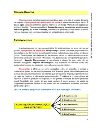 36
Necrose Gomosa
O nome vem da semelhança com goma arábica que é uma cola preparada de resina
de vegetais. É patognômica da sífilis tardia ou terciária e ocorre em qualquer tecido. É
devida ação antígenos-anticorpo, assim a necrose é um tecido inflamado em resposta ao
antígeno da sífilis (Treponema pallidum). Apresenta aspecto compacto e elástico como
borracha (goma), ou fluído e viscoso, concentração proteína não tão intensa quanto a
necrose caseosa, com centro necrosado e em volta células da inflamação.
Esteatonecrose
A esteatonecrose, ou Necrose enzimática do tecido adiposo, ou ainda necrose de
gordura, compromete os adipócitos. Fisiopatologia: lipases presentes no pâncreas são
secretadas na luz do intestino e circulação levando a metabolização dos lipídios em ácidos
graxos. Essas lipases são liberadas em excesso em trauma do tecido do adiposo ou na
pancreatite aguda (por processos infecciosos, viral, bacteriano ou principalmente por abuso
de álcool). Aspecto Macroscópico: é semelhante a pingos de vela, deixa de ser
amarelo homogêneo. Aspecto Microscópico: nos adipócitos se observa como uma
substancia arroxeada e o espaço às vezes só com um ponto (núcleo).
Pancreatite: o pâncreas ao sofrer agressões, entra em exaustão e começa a
produção de lipases em excesso (o pâncreas “soa” lipase) e “pinga” na cavidade peritoneal
e atinge as gorduras mesentérica e peritoneal que tem acumulo de gordura permitindo que
os vasos se deslizem e não ocorra sua compressão. O problema é porque a lipase vai
necrosar o tecido e produzir sua digestão, se for grande a necrose do tecido peritoneal
levará fragilidade dos vasos, porque essa gordura é quem protege os vasos da
compressão quando se deita ao dormir, assim sem ela pode ocorrer isquemias, por isso a
pancreatite é grave.
Obs: um exemplo de lipólise é as manchas roxas que ficam após uma batida.
 