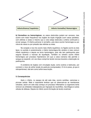 65
b) Vermelhos ou hemorrágicos: os vasos obstruídos podem ser venosos, mas
ocorre com maior frequência nos órgãos de dupla irrigação (com vasos paralelos,
com artérias e veias) e mesmo que a veia esteja obstruída a artéria continuará a
enviar sangue. O infarto pulmonar é vermelho, pois deve ocorrer hemorragia ou por
rotura de vasos ou por pressão das artérias ou veias.
No coração e nos rins ocorre mais infarto isquêmico; no fígado ocorre os dois
tipos; no pulmão é predominante o infarto hemorrágico.No cérebro é mais comum
infarto isquêmico e depois se torna hemorrágico, pois não tem parênquima para
segurar levando a necrose de liquefação. Também no cérebro ocorre infarto
hemorrágico por processo hipertensivo em que a caixa craniana não permite o
sangue se expandir, em vez disso comprime tecido nervoso levando a destruição do
parênquima.
O problema de órgãos com circulação dupla, como ovários e testículos, por
correrem o risco de sofrer torção do pedículo (compressão). O rim é preso, já que é
retroperitoneal, não tem como sofrer essa torção.
5. Consequências
Após o infarto, no espaço de até sete dias, ocorre cariólise, cariorrexe e
picnose celular. Mais é importante lembrar que só observam-se as membranas
celulares, assim em sete dias começa um processo inflamatório (o organismo tenta
remover as entidades indesejáveis) por migração de neutrófilos, macrófagos e outras
células de defesas. Depois do infarto ocorre formação de tecido cicatricial.
 