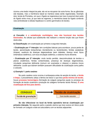 76
ocorreu uma lesão integral da pele, ela vai se recuperar de outra forma. Se as glândulas
são lesadas, mas a membrana basal se manteve estas serão regeneradas. Exemplo
dois: lenda de Prometeu, em que o fígado se regenerava (por isso é possível doar parte
do fígado entre vivos, já que este se regenera, a membrana basal do fígado contendo
veia centrolobular e células hepáticas é o centro germinativo do tecido).
Cicatrização
a) Conceito: é a substituição morfológica, mas não funcional dos tecidos
lesionados. As células que substituirão não realizam a mesma função das que foram
destruídas.
b) Classificação: em cicatrização por primeira e segunda intenção.
- Cicatrização por 1ª intenção: tem condições básicas para acontecer, pouca perda de
tecido, aproximação tempo/tempo (borda/borda ou tecido/tecido), feridas assépticas
(limpas), ausência de doenças degenerativas (sem diabetes, doença renal, lúpus
eritematoso sistêmico), com boa circulação sistêmica, e sistema imune eficiente.
- Cicatrização por 2ª intenção: muito tecido perdido, descontinuidade de tecidos e
planos anatômicos, feridas contaminadas, presença de doenças degenerativas,
circulação sanguínea deficiente (comum em acamados e obesos) e sistema imune
deficiente. Locais que dobram também possuem dificuldade de cicatrização como joelho
e cotovelo.
c) Exemplo 1: parto cesáreo
No parto cesáreo como ocorreu à antissepsia antes da secção do tecido, a ferida
é limpa, o procedimento utiliza a lâmina de bisturi o que leva perda mínima de tecido,
houve processo hemorrágico (formação de coágulo sanguíneo ajuda no processo de
formação de tecido cicatricial e produção de colágeno formando tecido fibroso). É uma
cicatrização de fora para dentro.
Se não infeccionar no local da ferida operatória tem-se cicatrização por
primeira intenção. No segundo parto a parede uterina que teve sutura em bloco pode
ter formado um coágulo e este se colou/aderiu com os tecidos adjacentes.
 