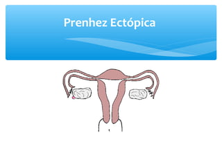 Prenhez Ectópica
 
