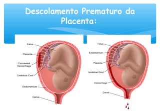 Descolamento Prematuro da
Placenta:
 