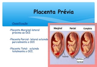 Placenta Prévia
∗ Classificação:
-Placenta Marginal-lateral
próximo ao OCI
-Placenta Parcial- lateral ocluindo
parcialmente o OCI
-Placenta Total- ocluindo
totalmente o OCI.
 