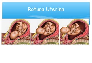 Rotura Uterina
 