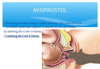 a) 800mcg em dose única a cada 24 horas, nos casos em que
a mulher optar por esperar o aborto no seu domicílio;
b) 400mcg de 12 em 12 horas;
c) 200mcg de 6 em 6 horas.
MISIPROSTOL
 