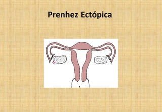 Prenhez Ectópica
 