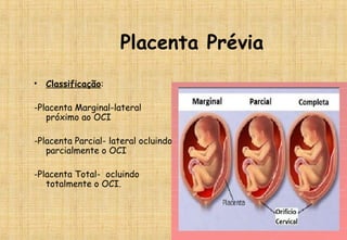 Placenta Prévia
• Classificação:
-Placenta Marginal-lateral
próximo ao OCI
-Placenta Parcial- lateral ocluindo
parcialmente o OCI
-Placenta Total- ocluindo
totalmente o OCI.
 