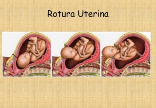 Rotura Uterina
 