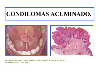 Patologia oral infección papiloma humano | PPT