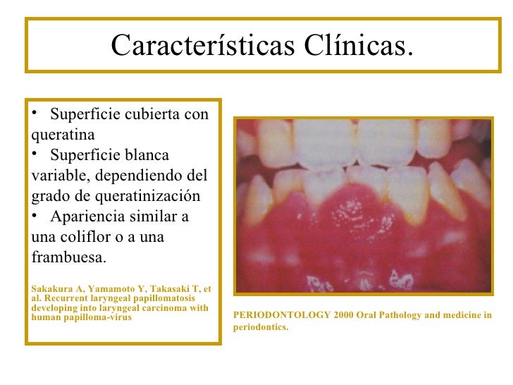 Patologia oral infección papiloma humano