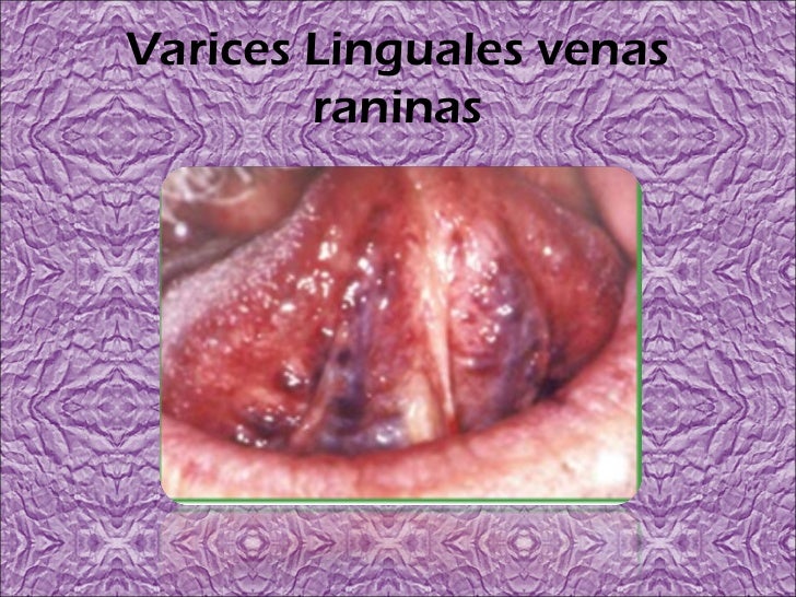Fotos De Varices En La Lengua