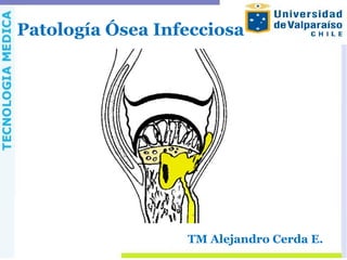 Patología Ósea Infecciosa
TM Alejandro Cerda E.
 