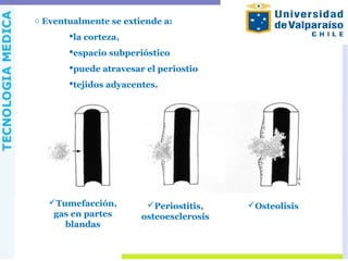 o Eventualmente se extiende a:
la corteza,
espacio subperióstico
puede atravesar el periostio
tejidos adyacentes.
Tumefacción,
gas en partes
blandas
Periostitis,
osteoesclerosis
Osteolisis
 