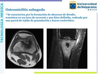 Osteomielitis subaguda
Se caracteriza por la formación de abscesos de Brodie,
consisten en un área de necrosis y pus bien definida, rodeada por
una pared de tejido de granulación y hueso esclerótico.
 