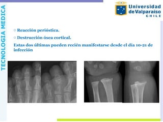 o Reacción perióstica.
o Destrucción ósea cortical.
Estas dos últimas pueden recién manifestarse desde el día 10-21 de
infección
 