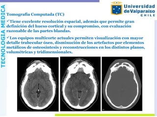 Tomografía Computada (TC)
Tiene excelente resolución espacial, además que permite gran
definición del hueso cortical y su compromiso, con evaluación
razonable de las partes blandas.
Los equipos multicorte actuales permiten visualización con mayor
detalle trabecular óseo, disminución de los artefactos por elementos
metálicos de osteosíntesis y reconstrucciones en los distintos planos,
volumétricas y tridimensionales.
 