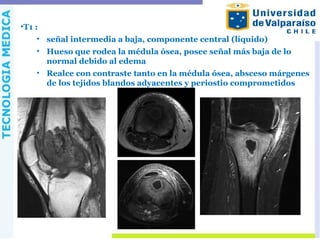 •T1 :
• señal intermedia a baja, componente central (líquido)
• Hueso que rodea la médula ósea, posee señal más baja de lo
normal debido al edema
• Realce con contraste tanto en la médula ósea, absceso márgenes
de los tejidos blandos adyacentes y periostio comprometidos
 