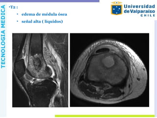 •T2 :
• edema de médula ósea
• señal alta ( líquidos)
 