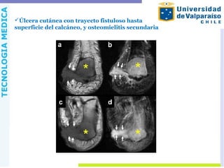 Úlcera cutánea con trayecto fistuloso hasta
superficie del calcáneo, y osteomielitis secundaria
 