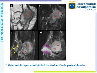  Osteomielitis por contigüidad tras infección de partes blandas
 