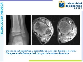 Colección subperióstica y periostitis en extremo distal del peroné.
Compromiso inflamatorio de las partes blandas adyacentes
 