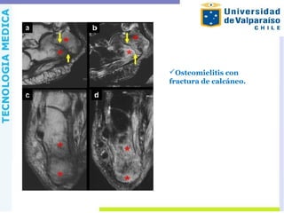 Osteomielitis con
fractura de calcáneo.
 