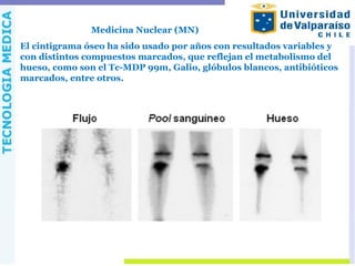 Medicina Nuclear (MN)
El cintigrama óseo ha sido usado por años con resultados variables y
con distintos compuestos marcados, que reflejan el metabolismo del
hueso, como son el Tc-MDP 99m, Galio, glóbulos blancos, antibióticos
marcados, entre otros.
 