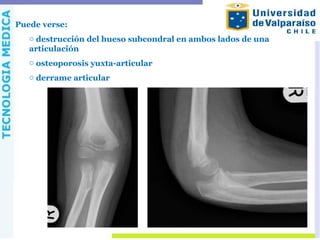 Puede verse:
o destrucción del hueso subcondral en ambos lados de una
articulación
o osteoporosis yuxta-articular
o derrame articular
 