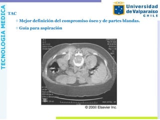TAC
o Mejor definición del compromiso óseo y de partes blandas.
o Guía para aspiración
 