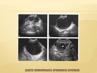 QUISTE HEMORRAGICO APARIENCIA DIVERSAS
 