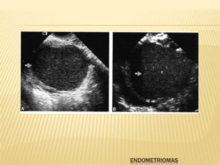 ENDOMETRIOMAS
 