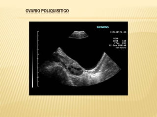 OVARIO POLIQUISITICO
 
