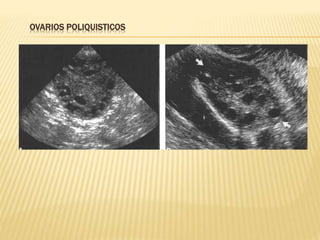 OVARIOS POLIQUISTICOS
 