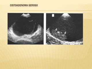 CISTOADENOMA SEROSO
 