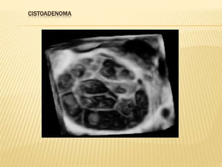 CISTOADENOMA
 