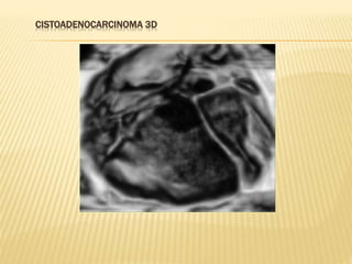 CISTOADENOCARCINOMA 3D
 