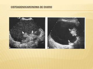 CISTOADENOCARCINOMA DE OVARIO
 