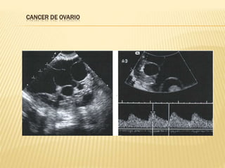 CANCER DE OVARIO
 