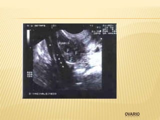 OVARIO
 