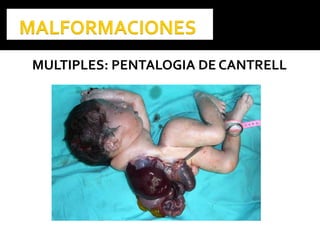 MULTIPLES: PENTALOGIA DE CANTRELL
 