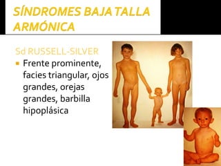 SdSd RUSSELLRUSSELL--SILVERSILVER
 Frente prominente,
facies triangular, ojos
grandes, orejas
grandes, barbilla
hipoplásica
 