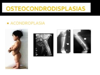  ACONDROPLASIAACONDROPLASIA
 
