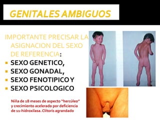 IMPORTANTE PRECISAR LAIMPORTANTE PRECISAR LA
ASIGNACION DEL SEXOASIGNACION DEL SEXO
DE REFERENCIADE REFERENCIA:
 SEXO GENETICO,
 SEXO GONADAL,
 SEXO FENOTIPICOY
 SEXO PSICOLOGICO
Niña de 18 meses de aspecto “hercúleo”
y crecimiento acelerado por deficiencia
de 11-hidroxilasa.Clítoris agrandado
 