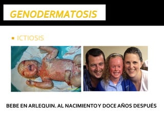  ICTIOSISICTIOSIS
BEBE EN ARLEQUIN.AL NACIMIENTOY DOCE AÑOS DESPUÉS
 