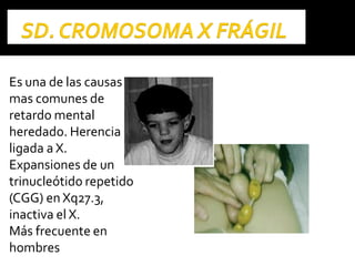 Es una de las causas
mas comunes de
retardo mental
heredado. Herencia
ligada a X.
Expansiones de un
trinucleótido repetido
(CGG) en Xq27.3,
inactiva el X.
Más frecuente en
hombres
 