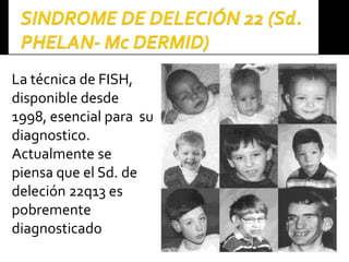 La técnica de FISH,
disponible desde
1998, esencial para su
diagnostico.
Actualmente se
piensa que el Sd. de
deleción 22q13 es
pobremente
diagnosticado
 