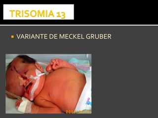  VARIANTE DE MECKEL GRUBERVARIANTE DE MECKEL GRUBER
 