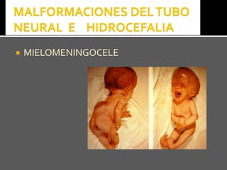  MIELOMENINGOCELEMIELOMENINGOCELE
 