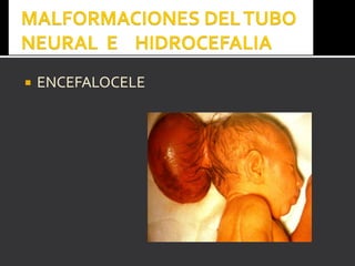  ENCEFALOCELEENCEFALOCELE
 